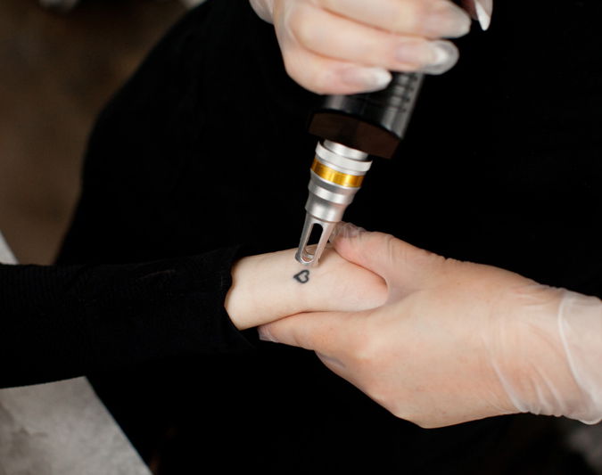 laser tattoo removal