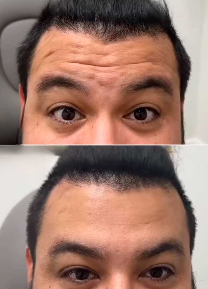 Wrinkle-treatment-Frisco