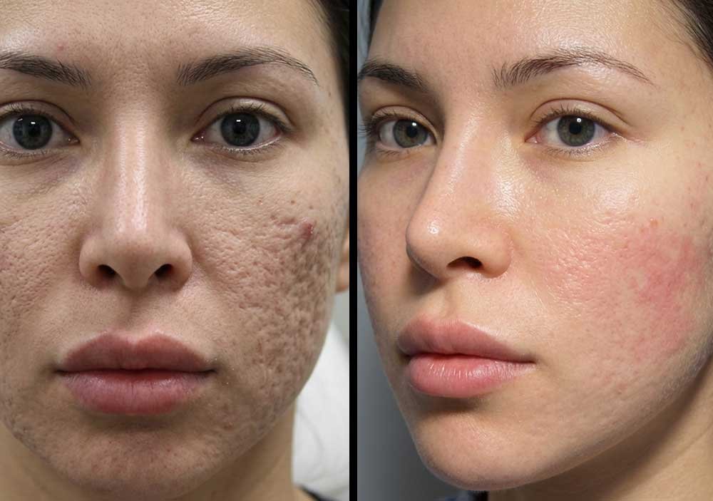 Acne-Acne-Scarring-gallery