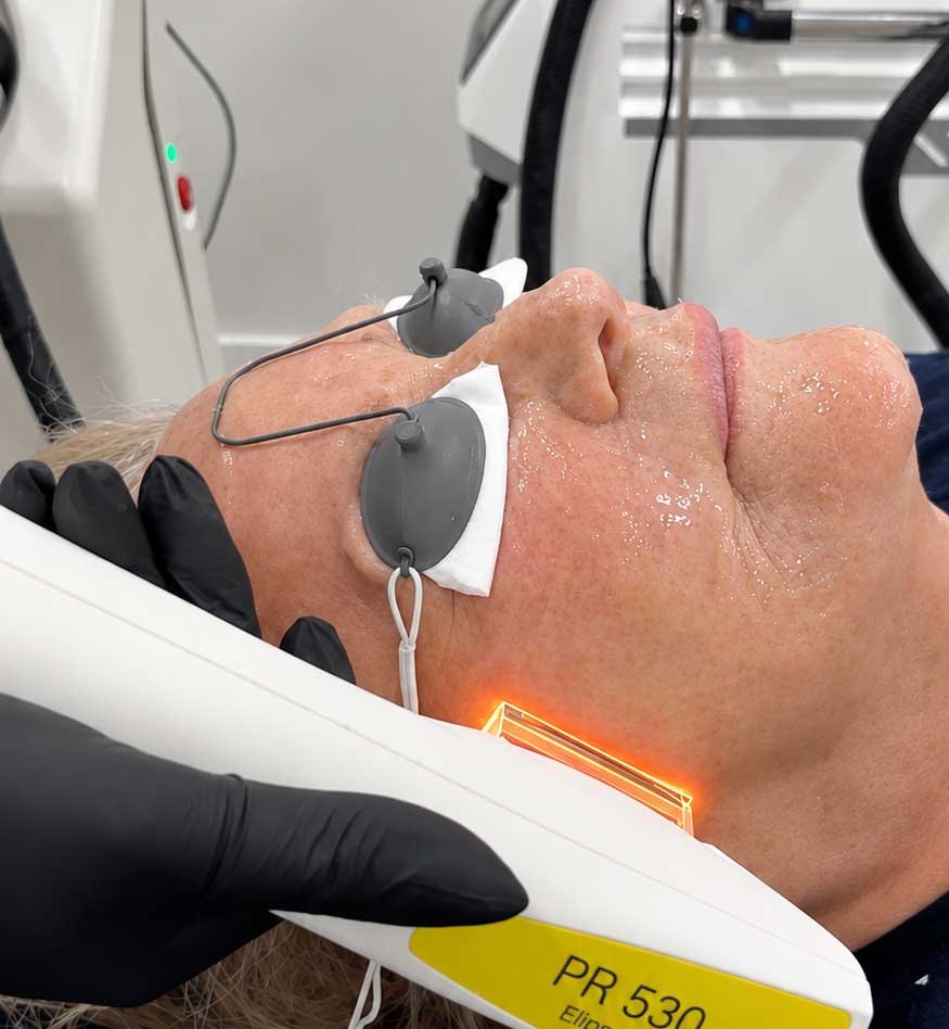 Laser Skin Brightening Frisco TX | Light & Bright Treatment