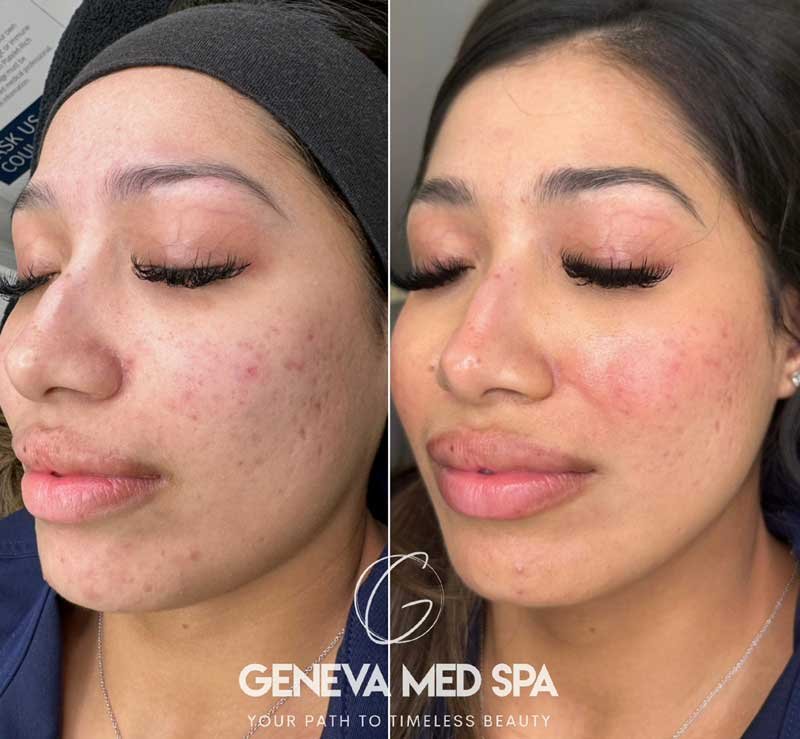 Chemical-Peel-Frisco-6