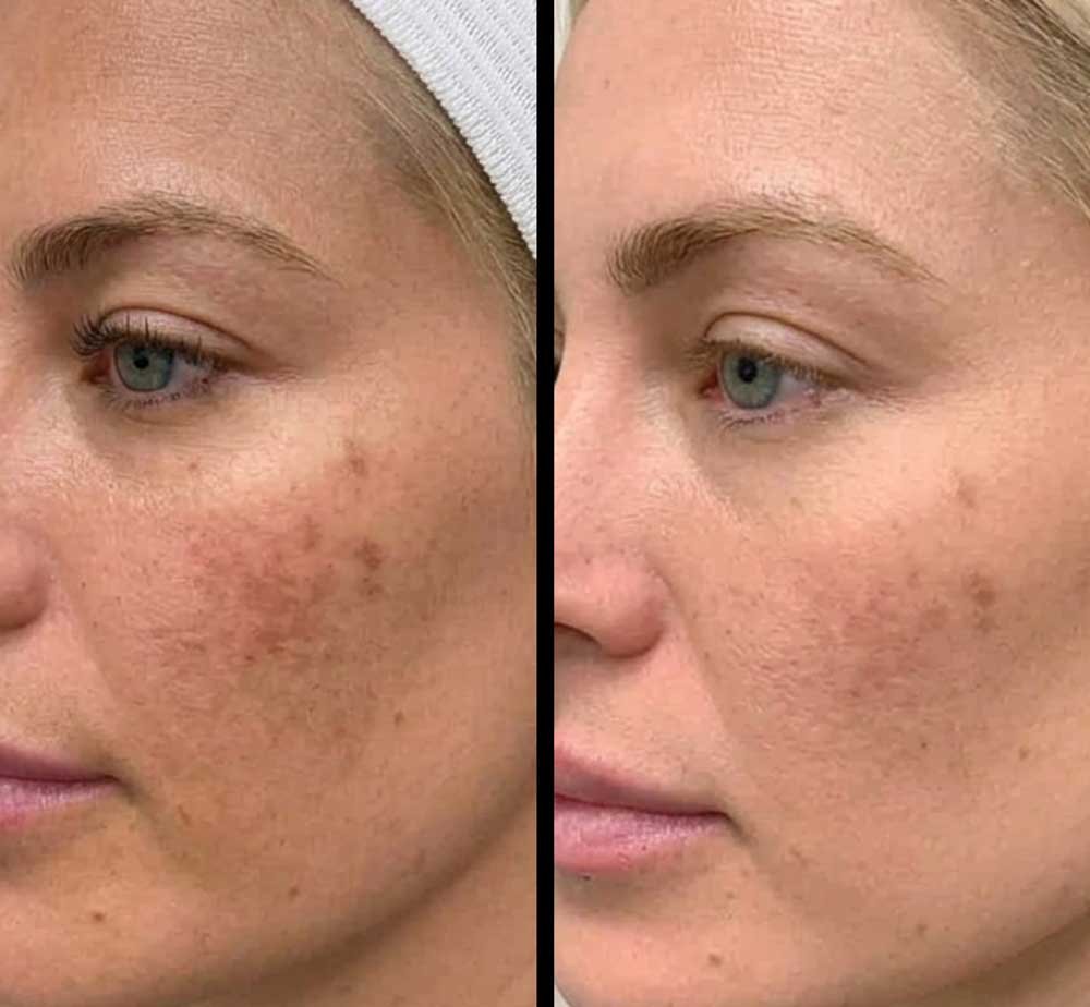 Chemical-Peel-Frisco-book