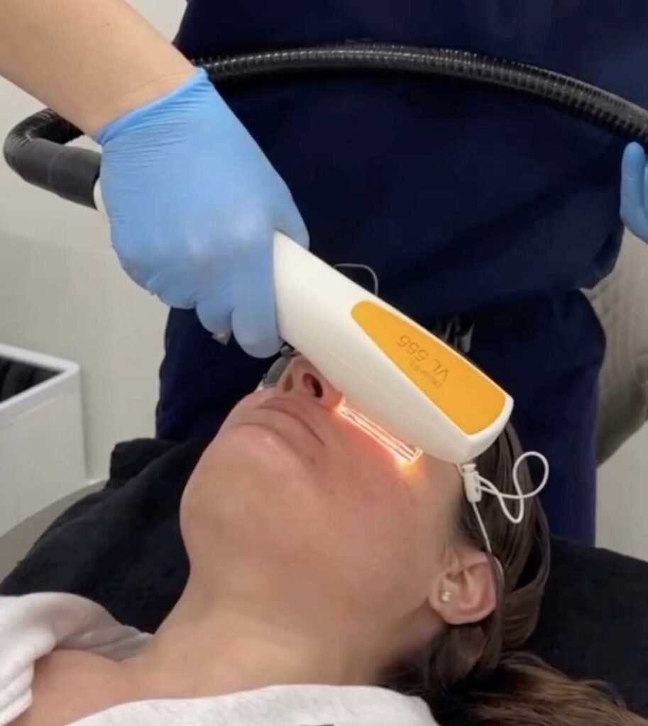 IPL Photofacial Frisco TX | Rosacea, Redness & Sun Damage