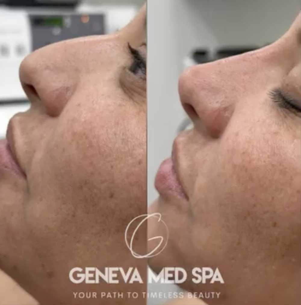 Liquid-Rhinoplasty-Frisco-gallery-2