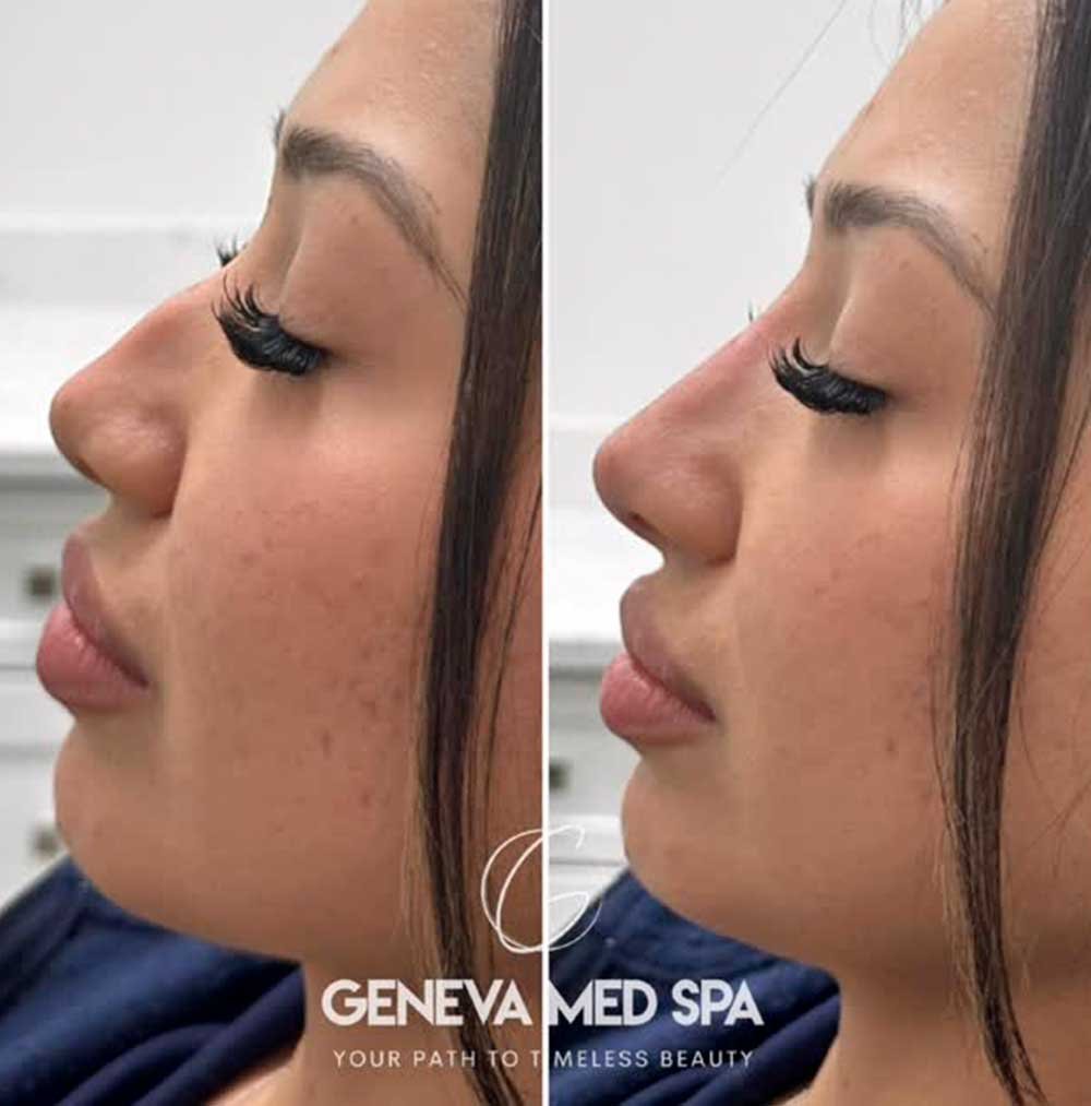 Liquid-Rhinoplasty-Frisco-gallery