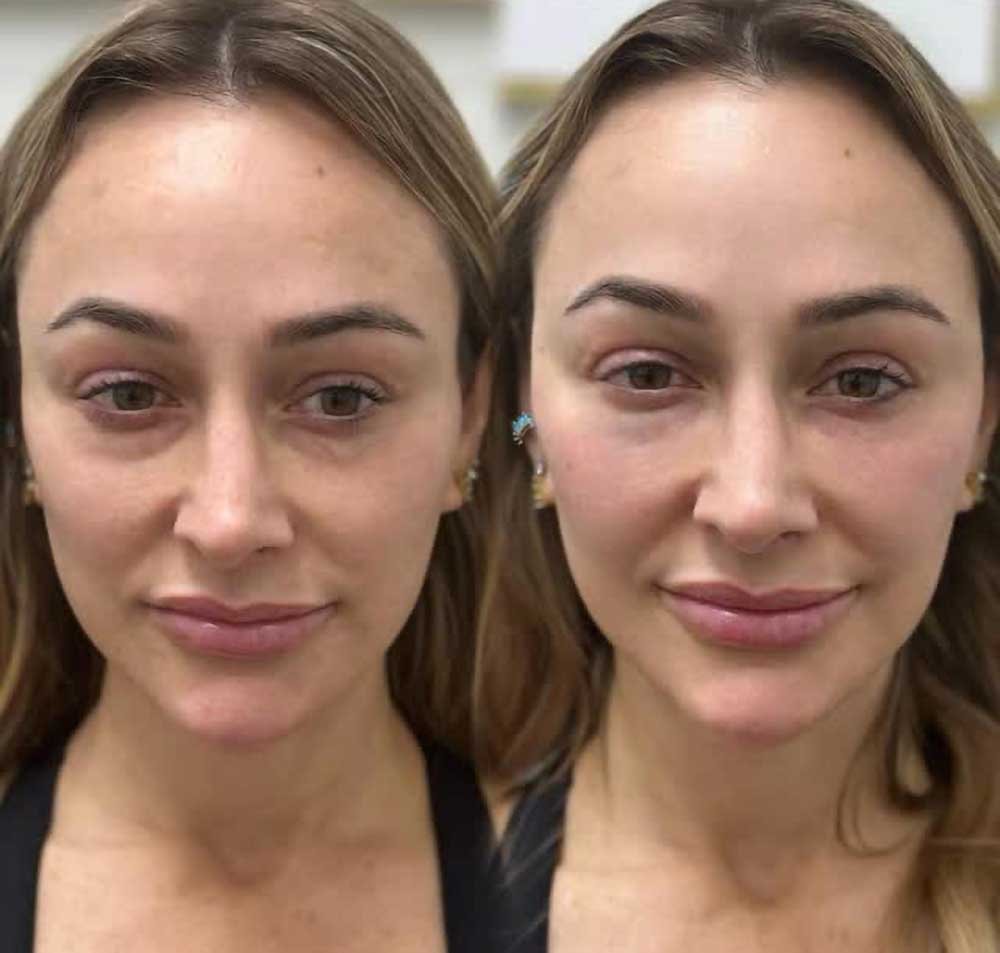 PRP-treatments-Frisco-Texas-gallery