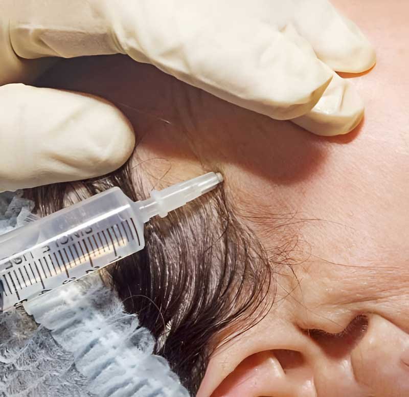 Poly-L-Lactic Acid Frisco TX | Collagen Stimulator Treatment