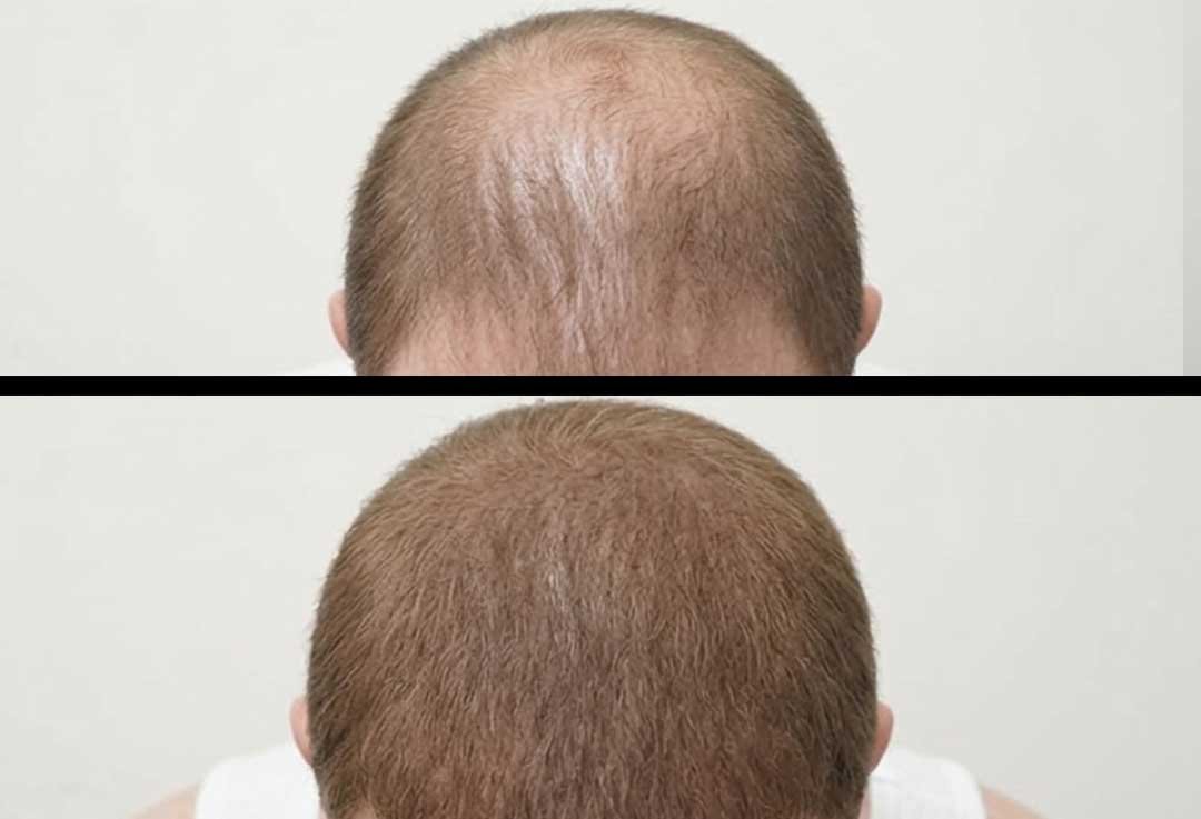 Scalp-Pigmentation-frisco-gallery-1
