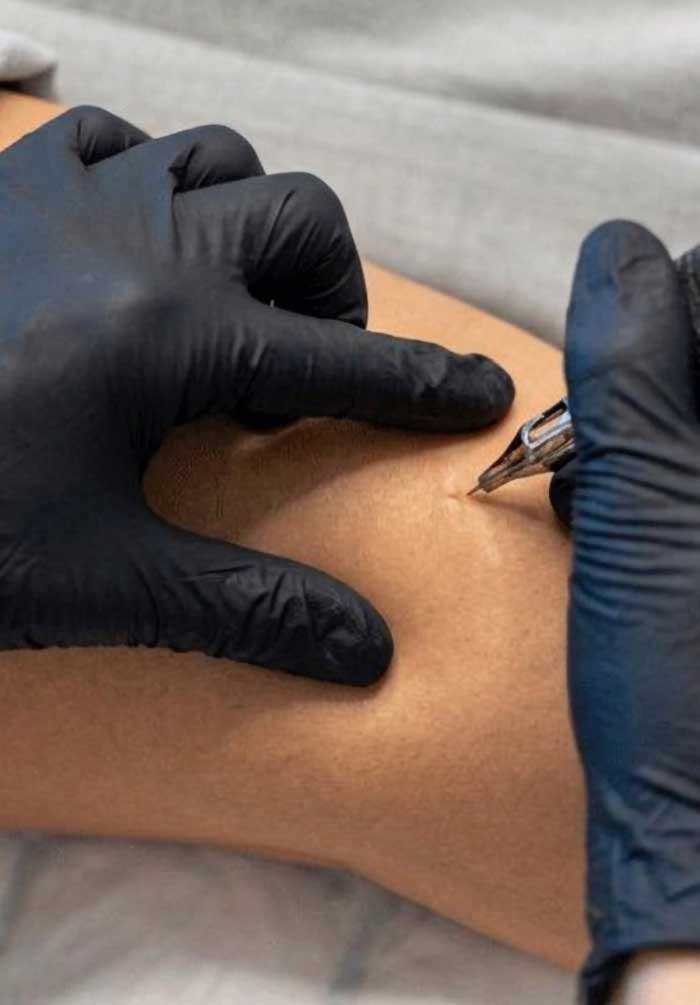 Scar Camouflage Frisco TX | Stretch Mark & Scar Tattooing