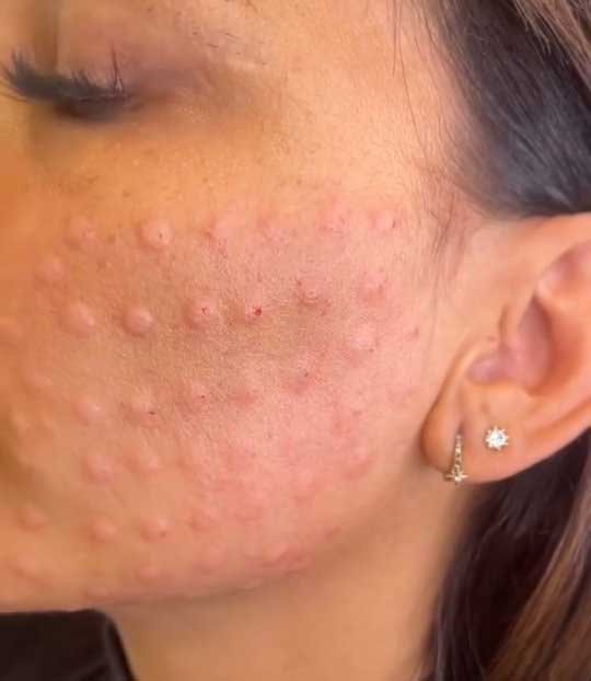 Skin Boosters Frisco TX | Mesotherapy & Hydrating Injectables