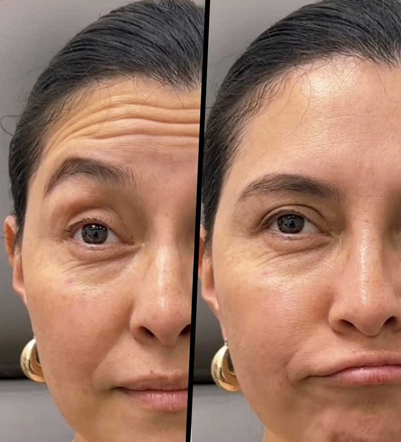 Wrinkle Treatment Frisco TX | Anti-Wrinkle Injections | Geneva Med Spa