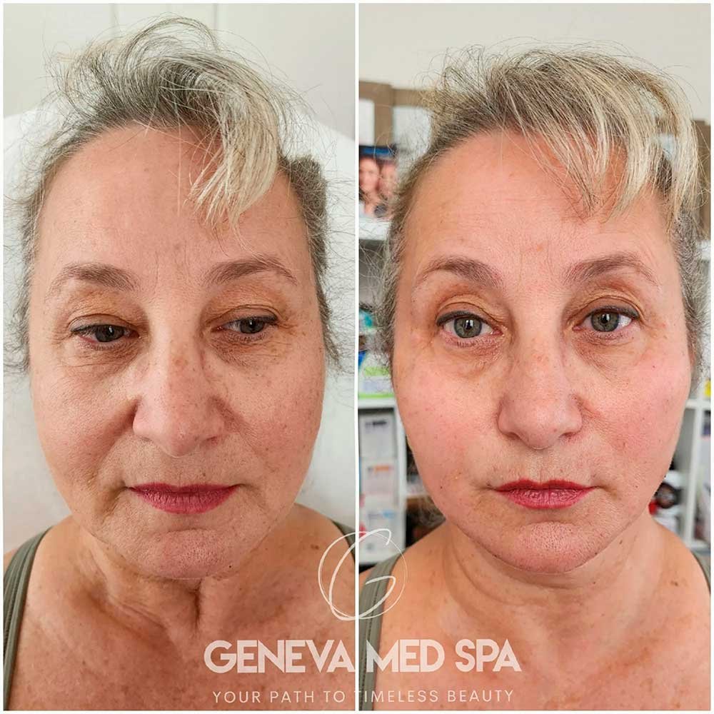 Wrinkle-Treatment-Frisco-gallery-1
