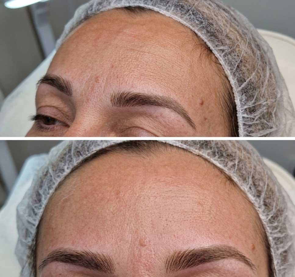 carbon-laser-peel-frisco-gallery-1
