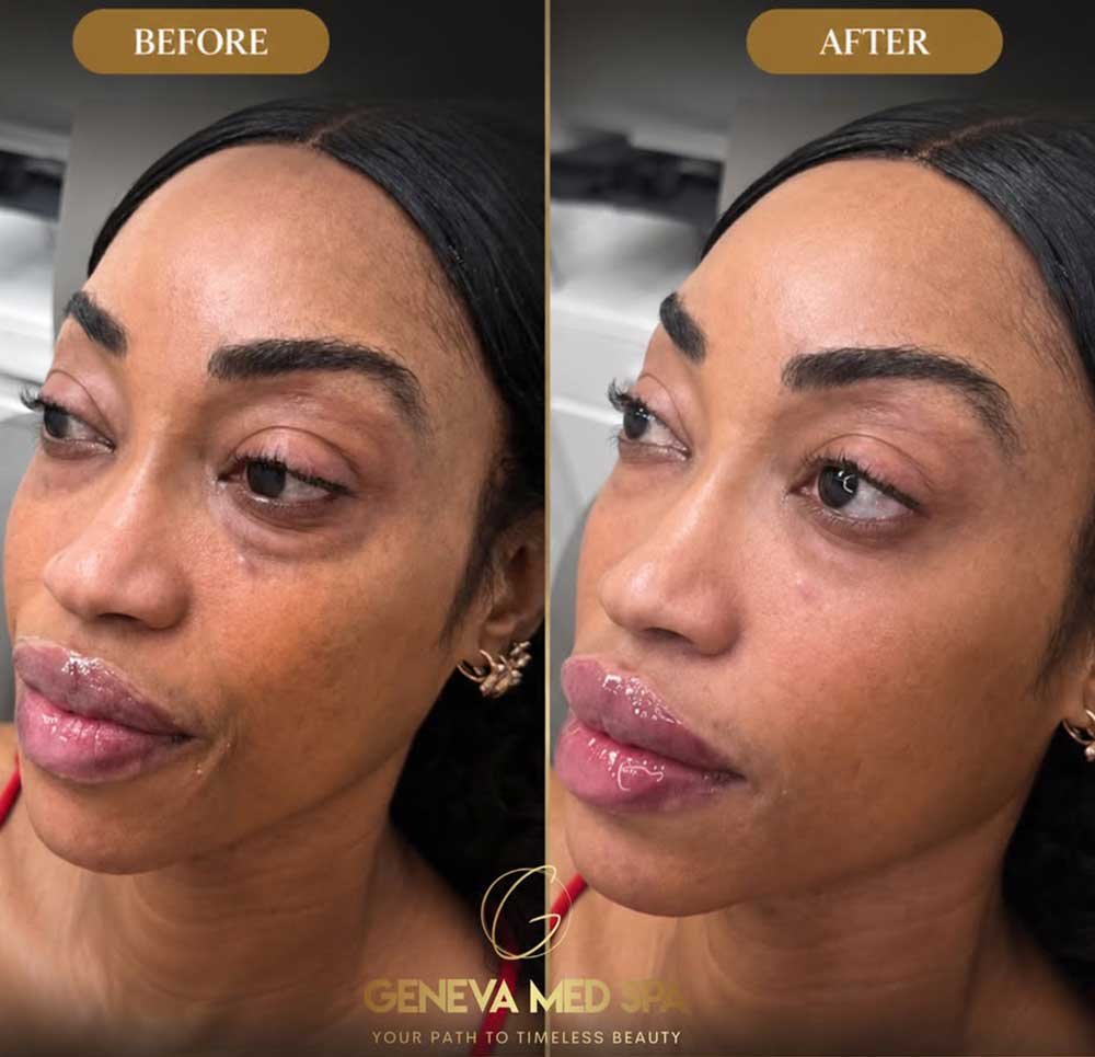 dermal-fillers-frisco-Texas-gallery-2
