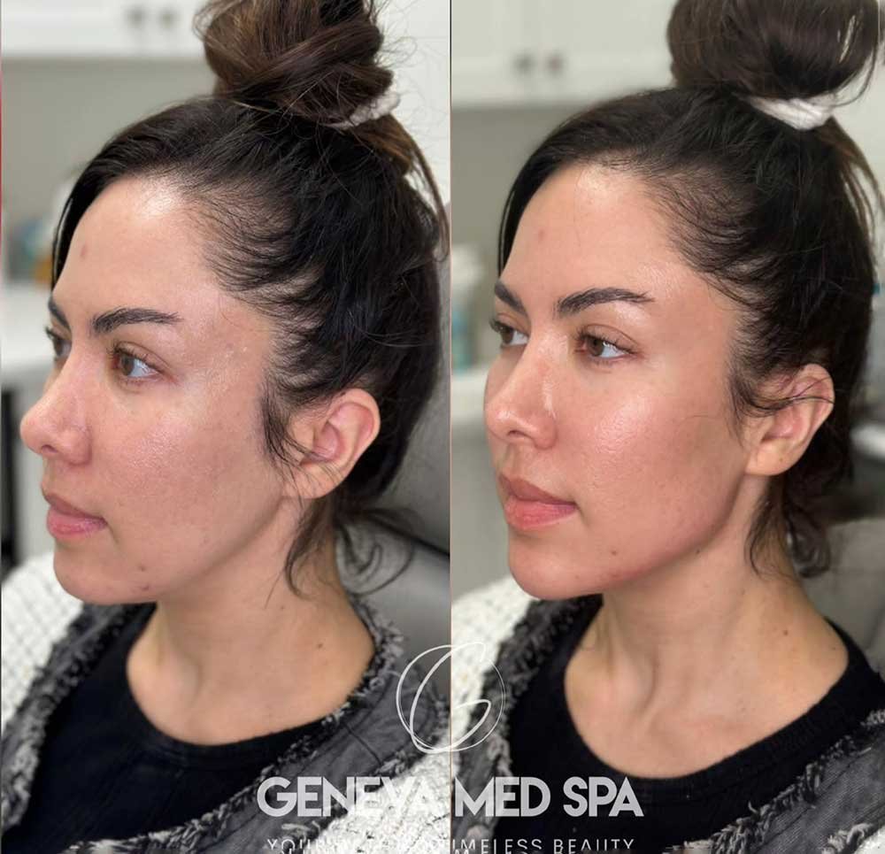 dermal-fillers-frisco-Texas-gallery-3