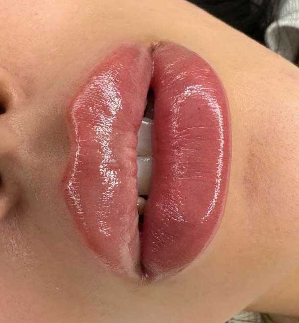 Lip Fillers Frisco TX | Natural Lip Enhancement