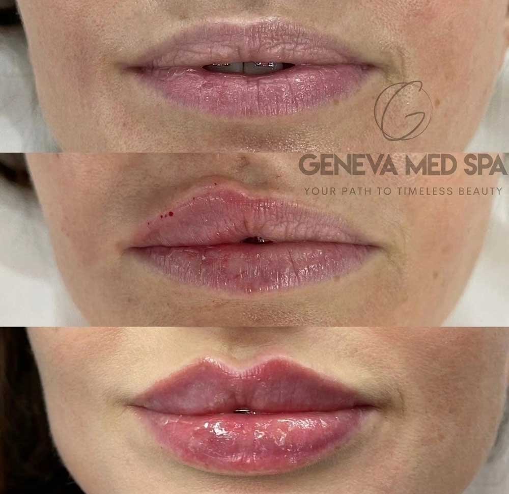 lip-filler-frisco-gallery-4