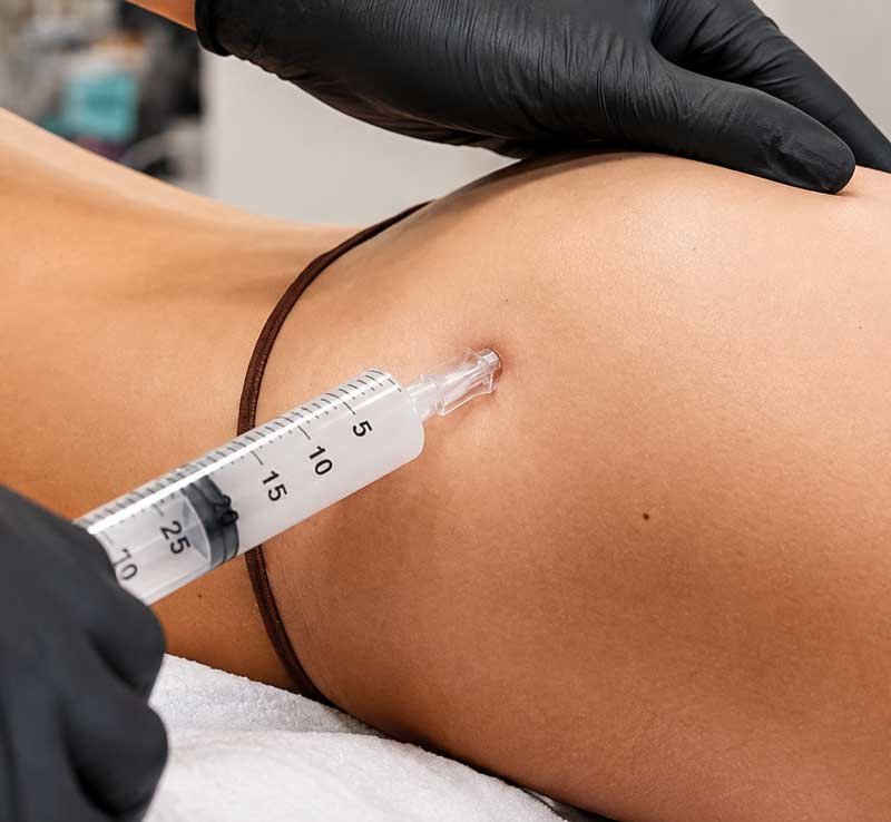 Liquid BBL Frisco TX | Non-Surgical Butt Lift