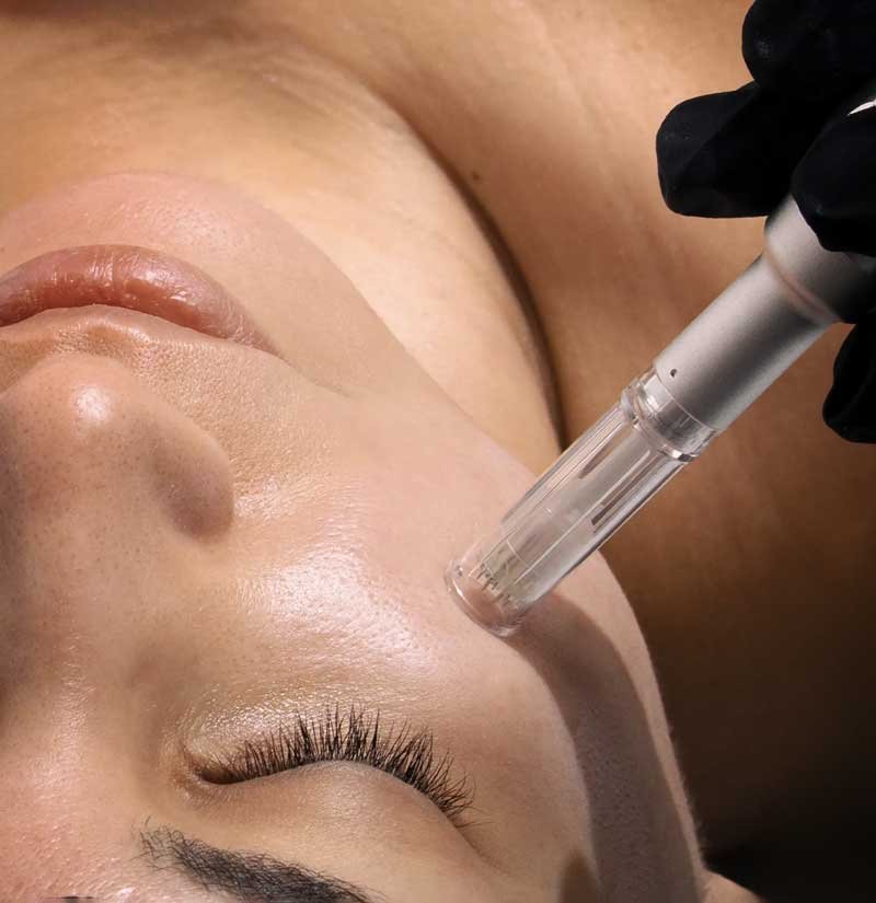 Microneedling Frisco TX | Collagen Induction & Acne Scars