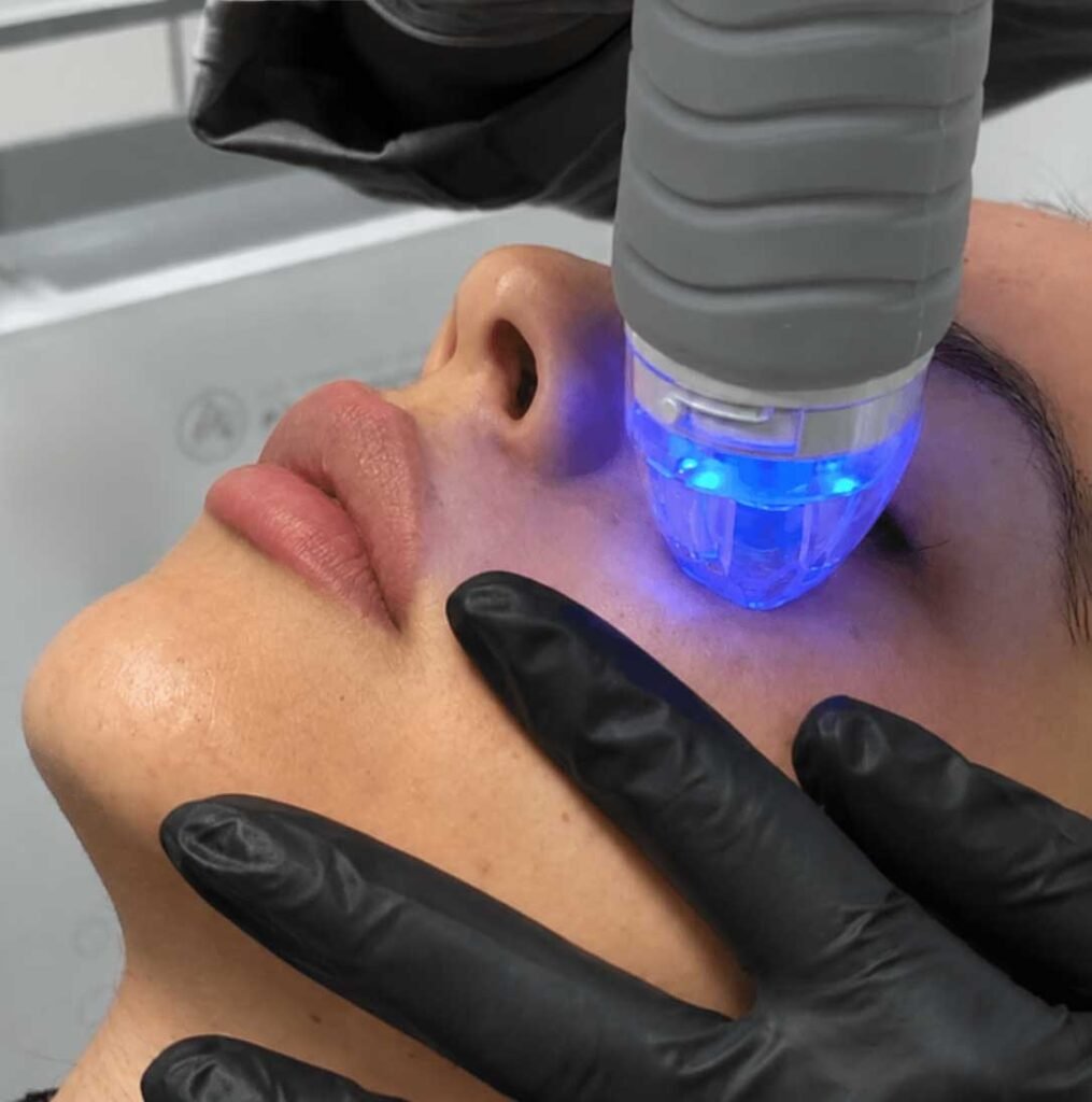RF Microneedling Frisco TX | Skin Tightening & Texture