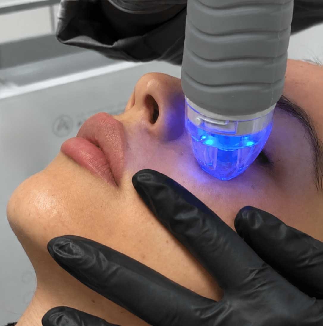 RF Microneedling Frisco TX | Skin Tightening & Texture