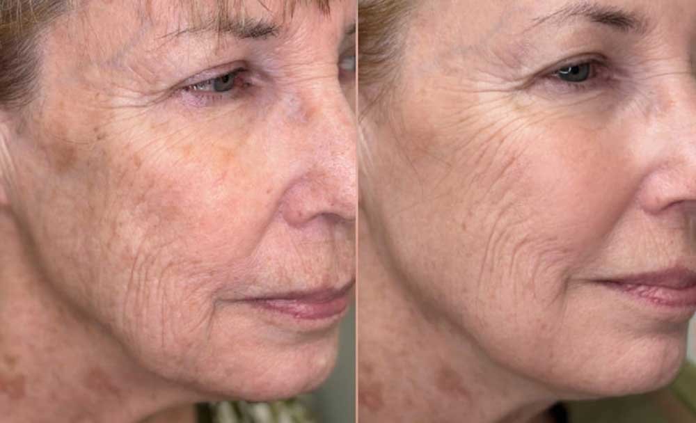 rf-microneedling-frisco-gallery-2