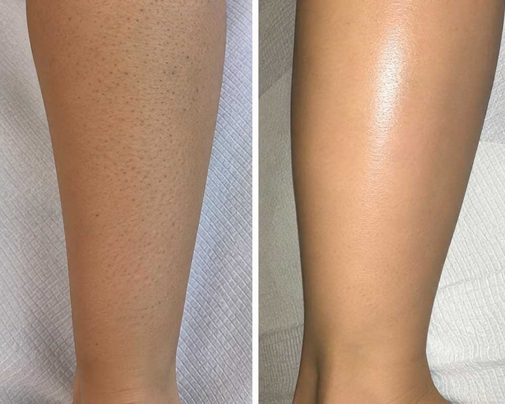 Laser-Hair-Removal-gallery_4
