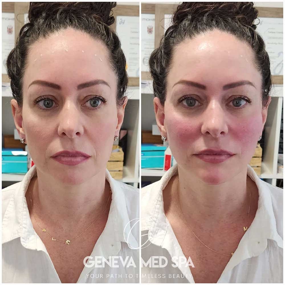 Non-surgical-Face-Lift-gallery