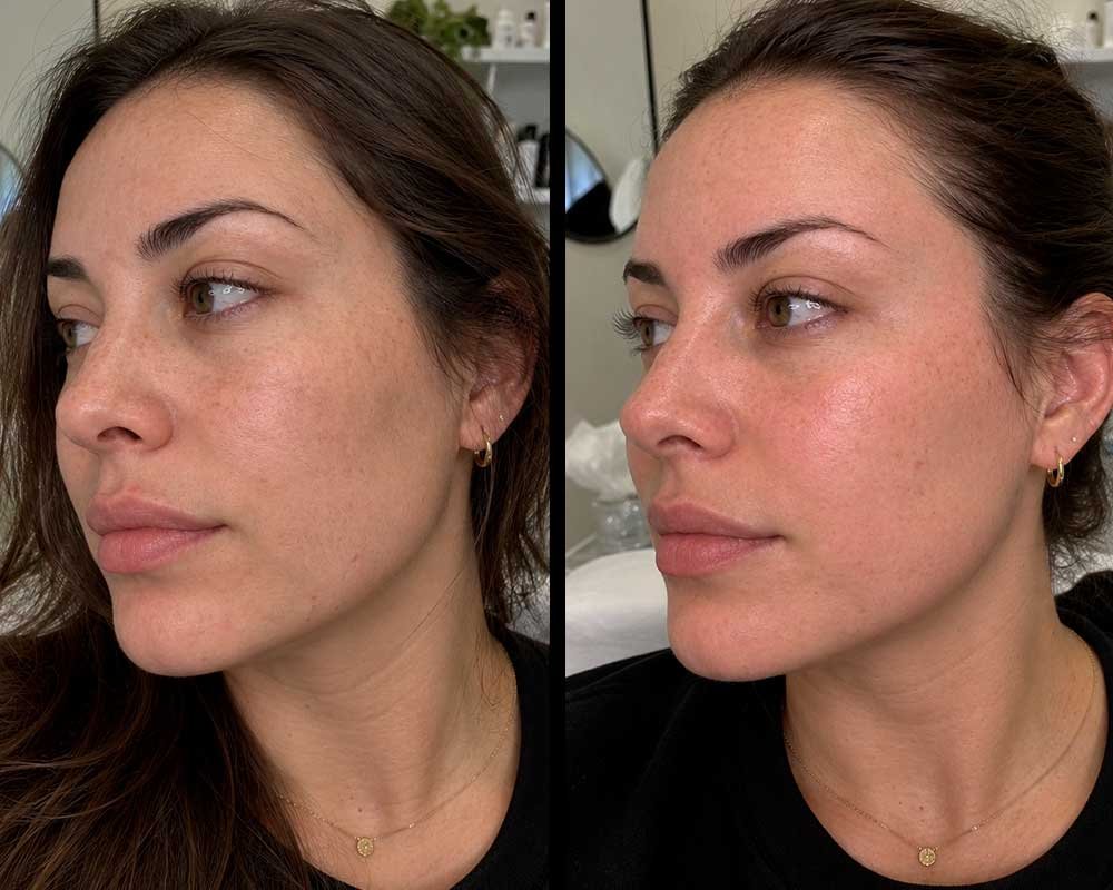 dermaplaning-frisco-texas-gallery-1