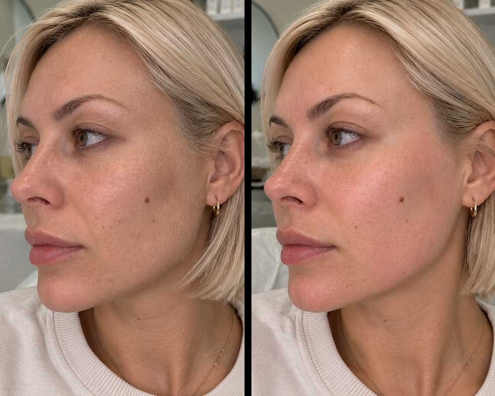 dermaplaning-frisco-texas-gallery-2