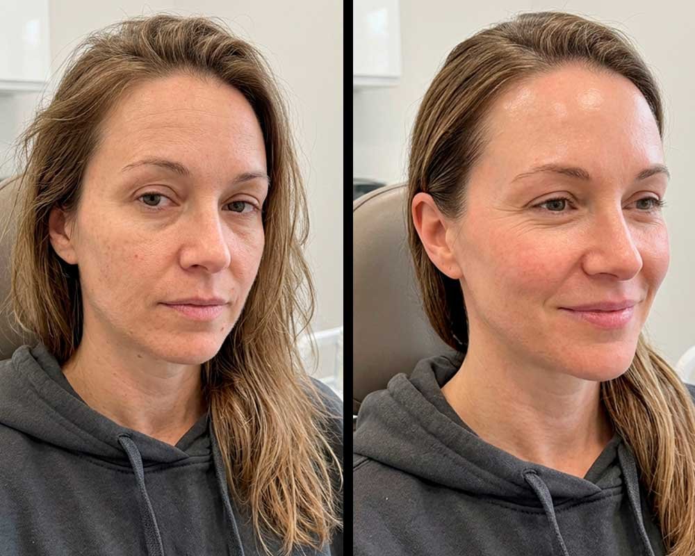 dermaplaning-frisco-texas-gallery