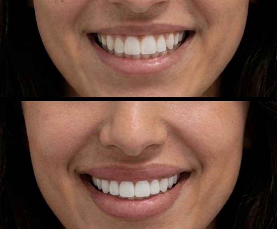 lip-flip-frisco-galler-2