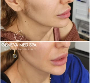 lip filler