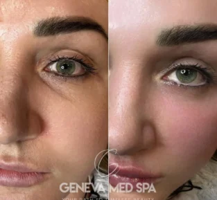 tear trough filler