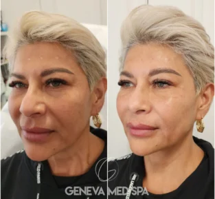 non-surgical face lift