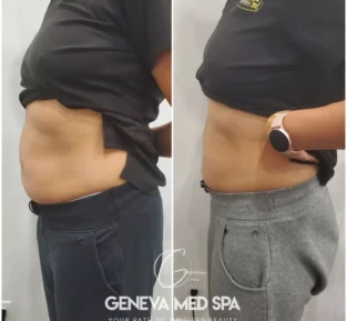 non-surgical fat reduction