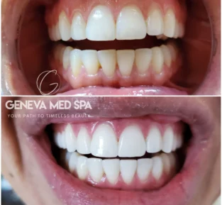 teeth whitening