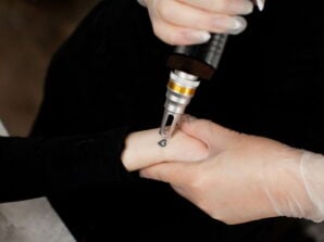 laser tattoo removal laser tattoo removal