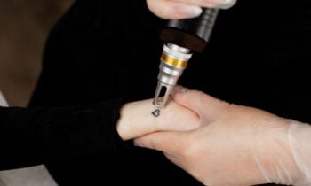 laser tattoo removal laser tattoo removal