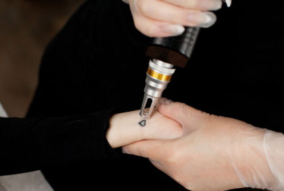 laser tattoo removal