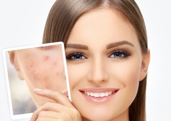 acne removal