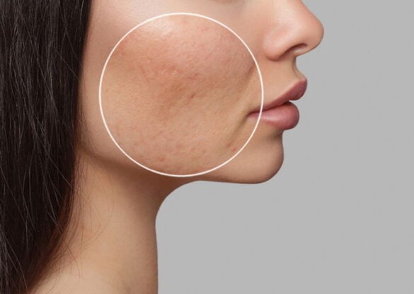 acne removal