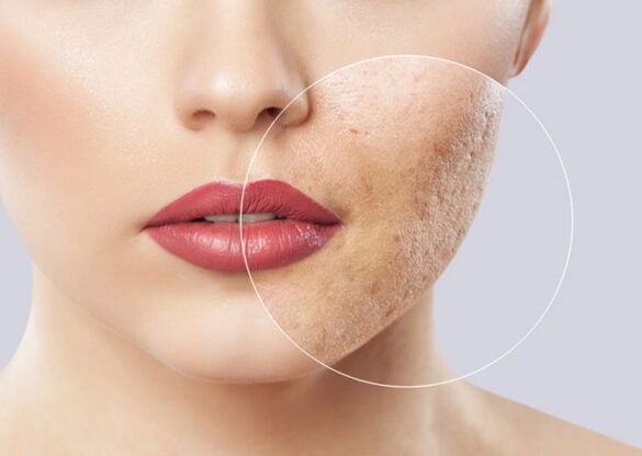 acne removal