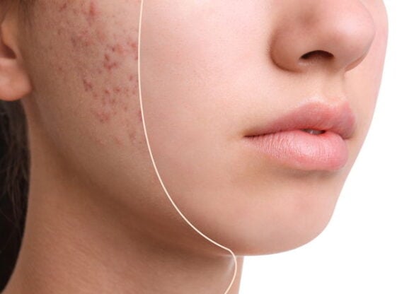 girl with acne