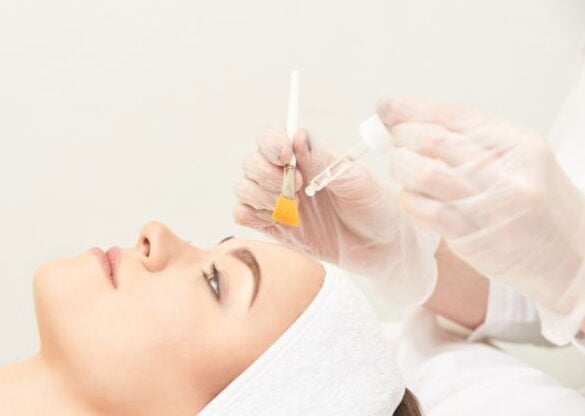 Retinol Chemical Peel