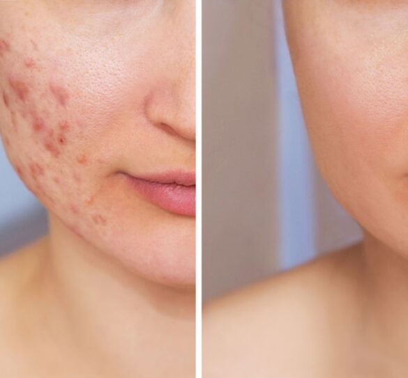 Cropped,Shot,Of,A,Young,Woman's,Face,Before,And,After Before and After Acne Treatment