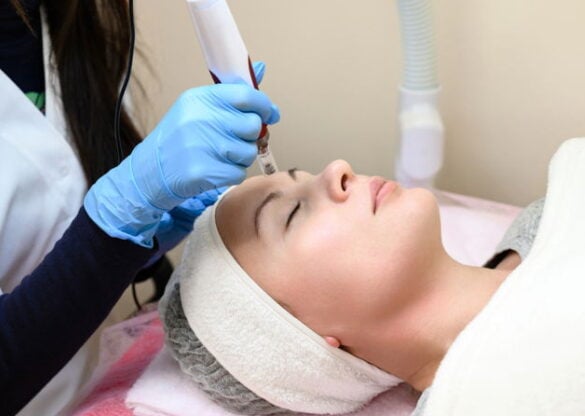 Microneedling with Chemical Peel