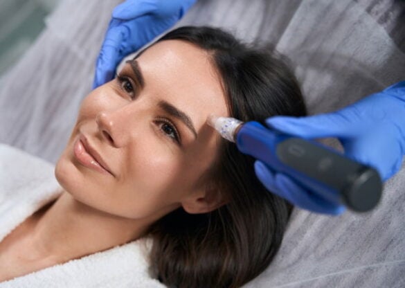 Microneedling
