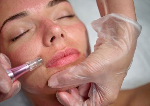 Microdermabrasion